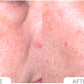 Acne Control System