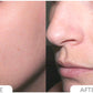 Acne Control System