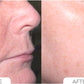 Acne Control System