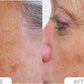 Acne Control System
